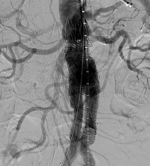 THERAPEUTIC ENDOANCHORS WITH INDEX EVAR Post EndoAnchors completion angiogram: