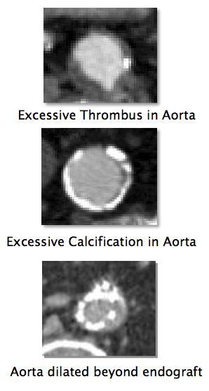 To Lock Graft to the Aorta, EndoAnchors Must Penetrate Aortic
