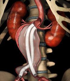 circumference Porcelain aorta (severe circumferential