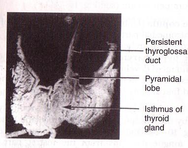 The upper end of duct persists in the dorsum of the tongue as the foramen cecum.