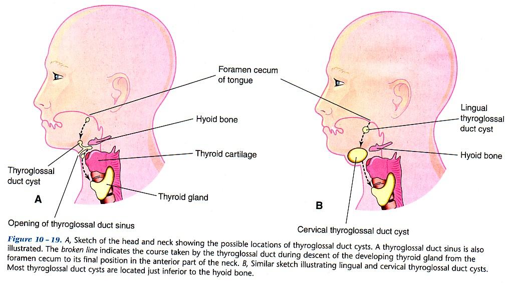 Thyroglossal cyst A, showing the possible locations of thyroglossal duct cysts at the broken line indicating the course of the duct.