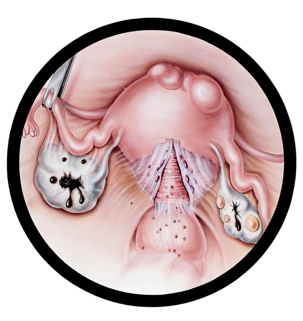 menstrual period. The pain may be felt toward the sides, in the middle or very deep within the pelvis. (dis puh roo nee uh) - that can feel like something being hit at the back of the vagina.