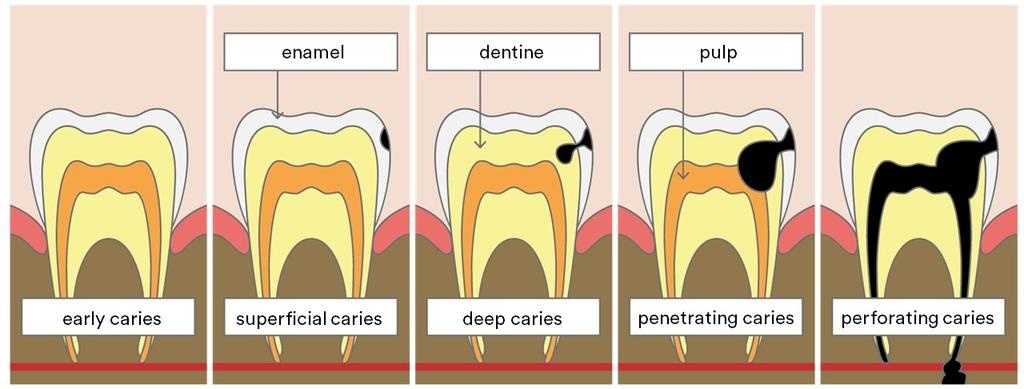 Answers Tooth decay [11-13 years old and 14-16 years old] Tooth caries, commonly known as tooth decay, is not linked with the normal functioning of the digestive tract; it is the result of an