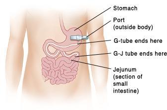 muscles of the abdomen to increase gastric emptying Feeding Tube