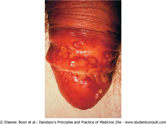 Genital HSV Herpetic ulceration of the