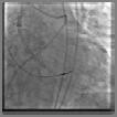 Positioning Deployment Release Angiographic