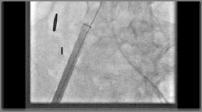 aortic bifurcation Sheath removal Arteriotomy repair If iliac artery