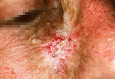 Premalignant skin tumours page: 443 Radiodermatitis Cicatricial atrophy, telangiectases, and pigmentation abnormalities form the classical of radiodermatitis.