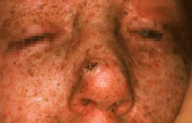 Premalignant skin tumours page: 444 Xeroderma pigmentosum A hereditary disease with recessive autosomal transmission.