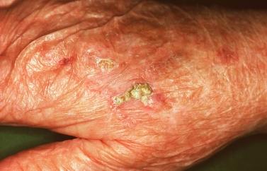 Premalignant skin tumours page: 435 Solar keratoses (senile keratoses) Raised red and well-defined plaques with a rough surface covered in scales of varying thickness.