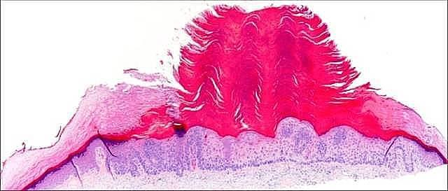 Dysplasia starts at the basal layer. Look at the dysplastic basal cells.