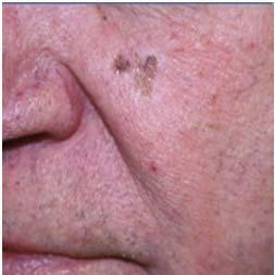 Melanoma sub types Lentigo maligna melanoma (LM) Hutchinson s melanotic freckle is a pigmented macular lesion. Sun damaged skin.