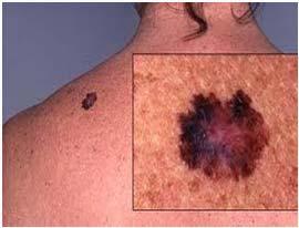 Lentigo maligna Superficial spreading melanoma Most common. Lateral growth before invasion. Young patients.