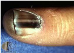 Subungual melanoma Variant of ALM. Nail matrix. Brown to black stripe.