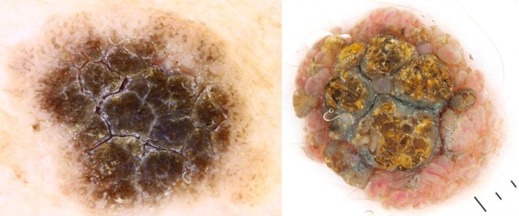 In the centre a pattern of red and purple clods, with no linear vessels is consistent with a haemangioma. On the right a pattern of blue clods points confidently to the diagnosis of BCC.