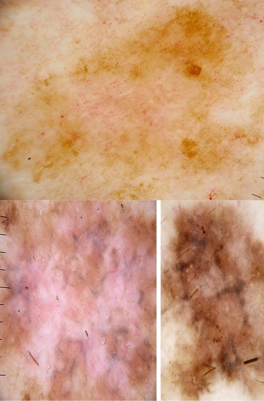 Figure 14: Clues to melanoma: Asymmetry plus: polymorphous vessels and