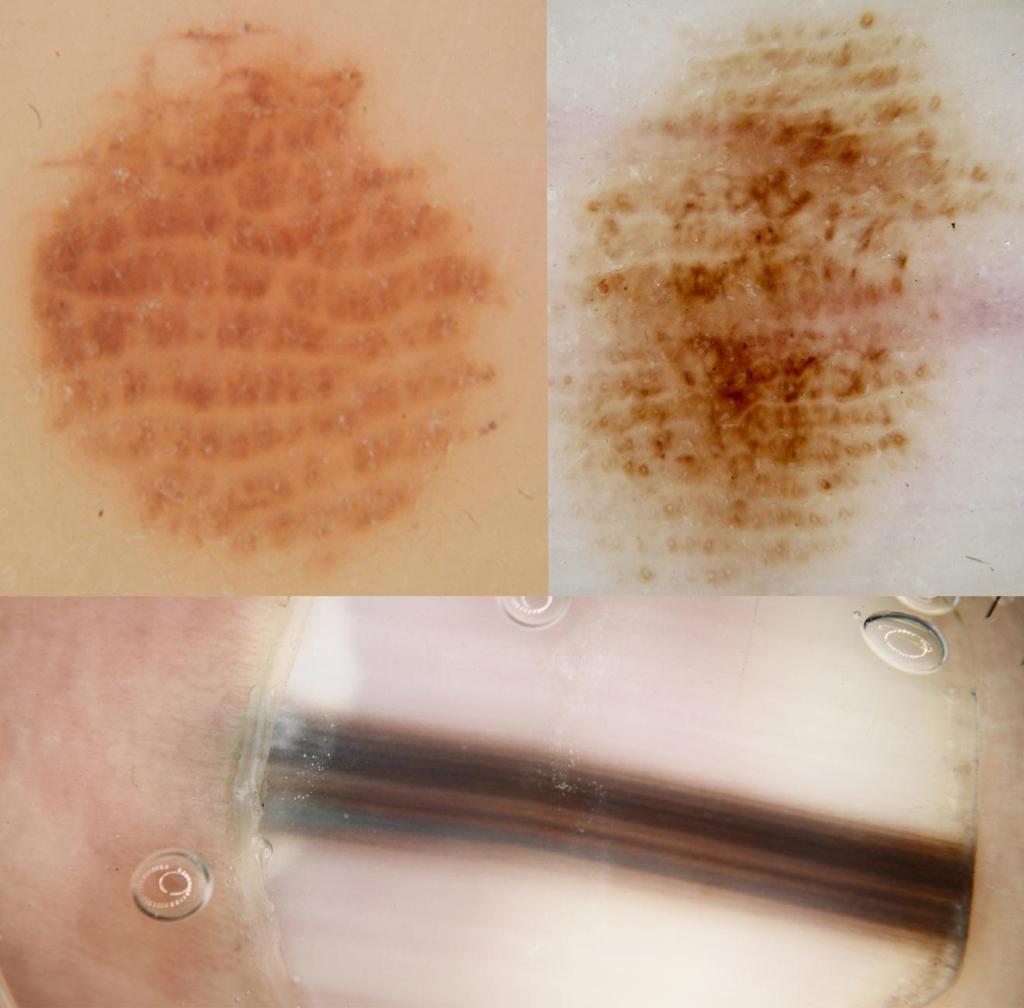 Figure 16: Clues to melanoma on acral skin and the nail matrix: The upper images are of patterns of parallel lines on the dermatoglyphic ridges on acral skin.