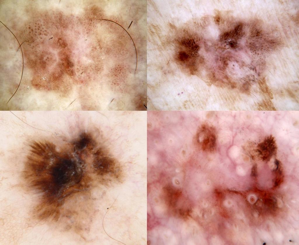 Clues to pigmented SCC in situ In a study of 52 consecutive cases of pigmented SCC in situ (pigmented Bowen s disease) the lesions were typified by the absence of a pattern of reticular lines and by