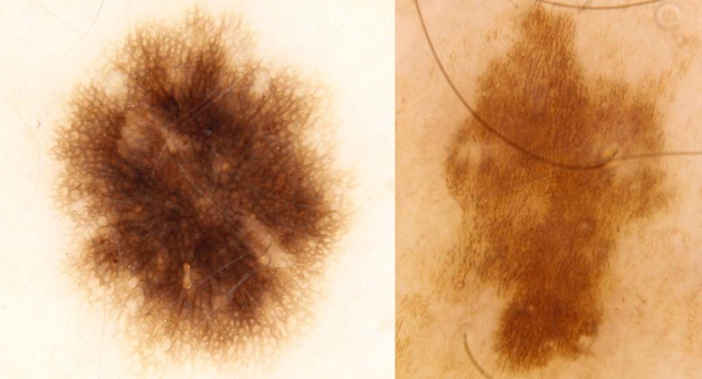 Interpreting various dermatoscopic patterns Clues to naevus versus solar lentigo This distinction is not always possible without dermatopathology, but as a rule a naevus is expected to have a gradual