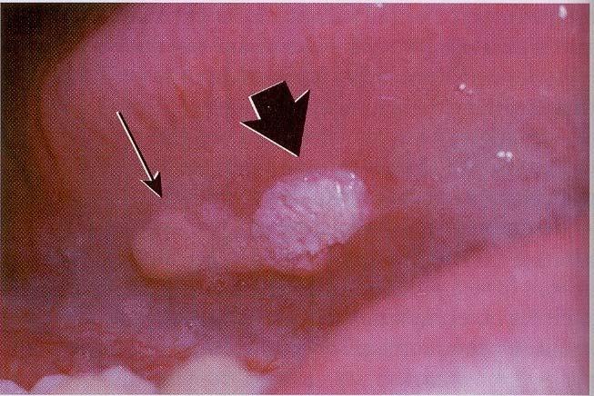 alveolar mucosa Manifestation: well demarcated, soft, painless