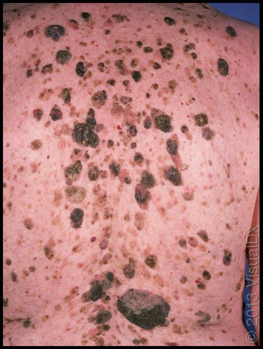 Seborrheic Keratoses begin developing usually in 30s & become ubiquitous in elders increase in number throughout life range from few hundreds