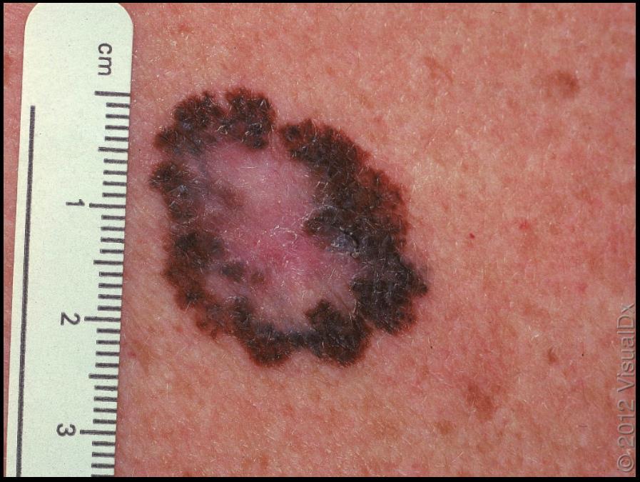 How can I tell if a lesion is a seborrheic keratosis?