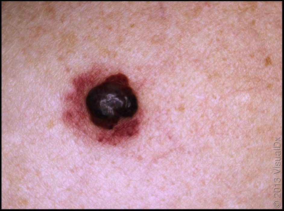 Cherry angioma can mimic melanoma