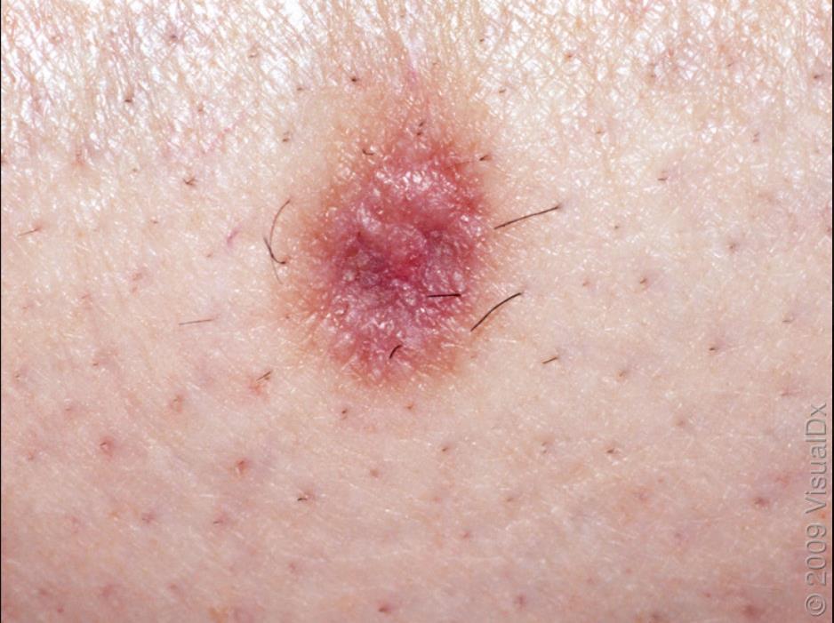 What do you do next? A. Biopsy the lesion B. Refer to Dermatology C.