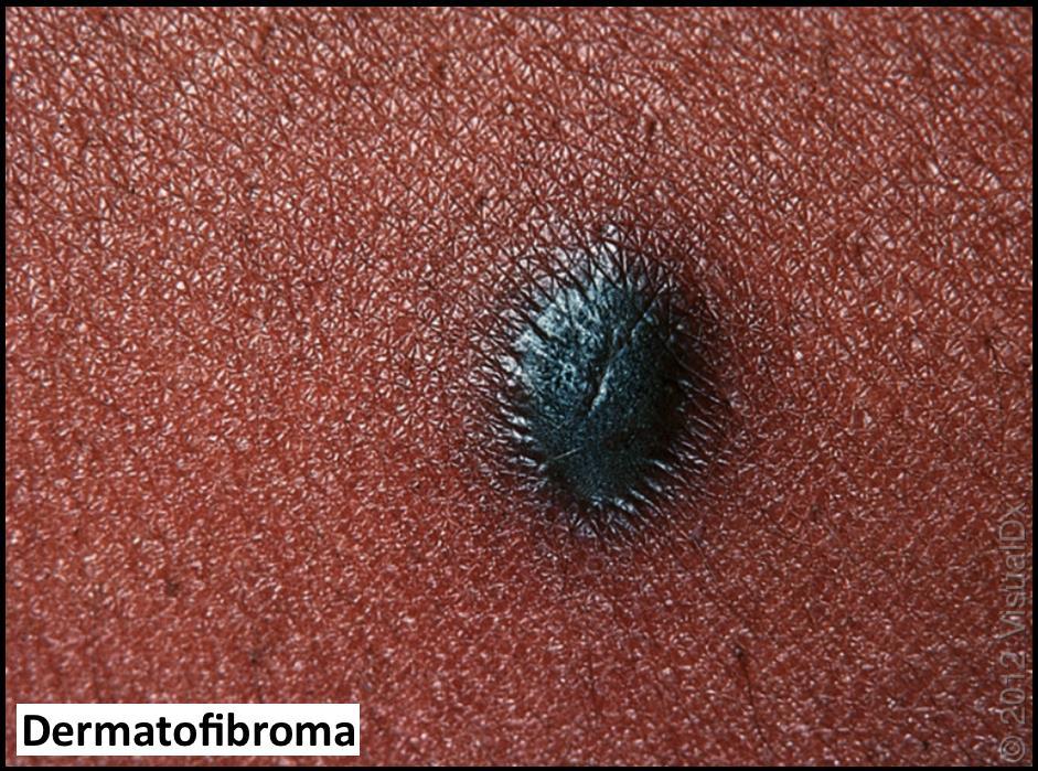 Dermatofibroma second most common bengin