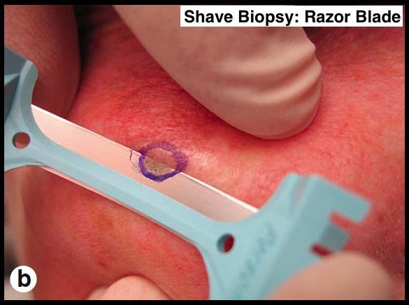Shave Biopsies & Pathology Shave Biopsies quick,