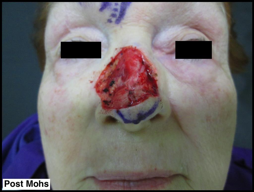 Post Mohs Surgery for BCCs