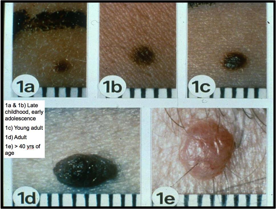 Evaluating Melanocytic Lesions acquired melanocytic nevi are common in childhood & early adulthood related to sun exposure nevi change overtime esp.