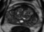 Prostate and NVB anatomy and MR images.