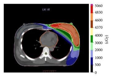 Summary We have developed a novel approach to improve 3D NVB localization through MR-TRUS fusion for prostate RT, demonstrated its clinical feasibility, and validated its accuracy with ultrasound