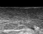 8 mm Clinical Significance of Ultrasound Measurements in Women Treated with