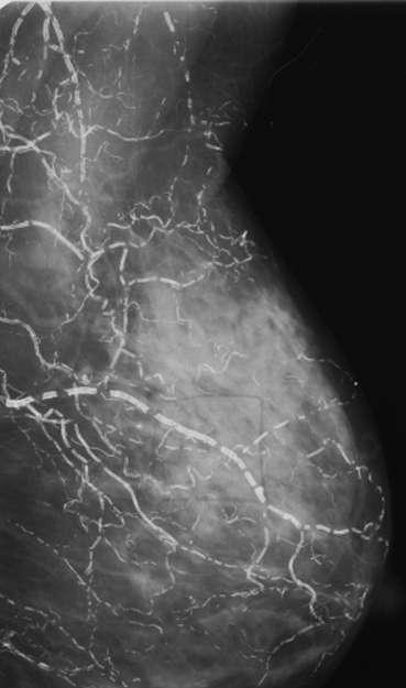 asymmetric Early arterial calcification may be