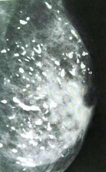 Duct ectasia Usually bilateral and symmetric, large calcification Nipple
