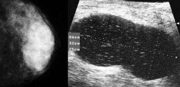 Final assessment BI-RADS: 0 Need additional imaging evaluation and or prior