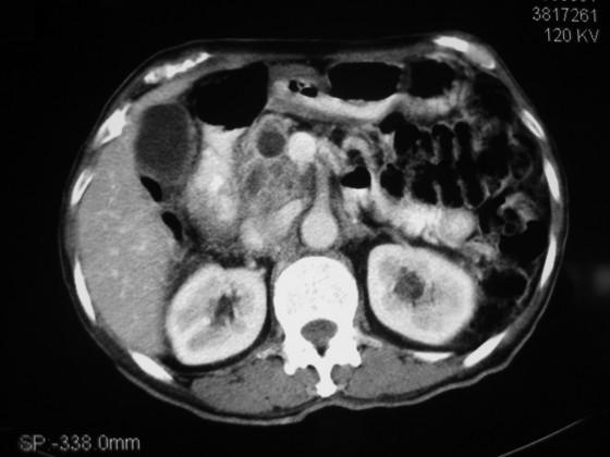 5 compatible with carcinoma (Image 3). The patient underwent exploratory laparotomy whereby the entire pancreas demonstrated features compatible with IPMN.
