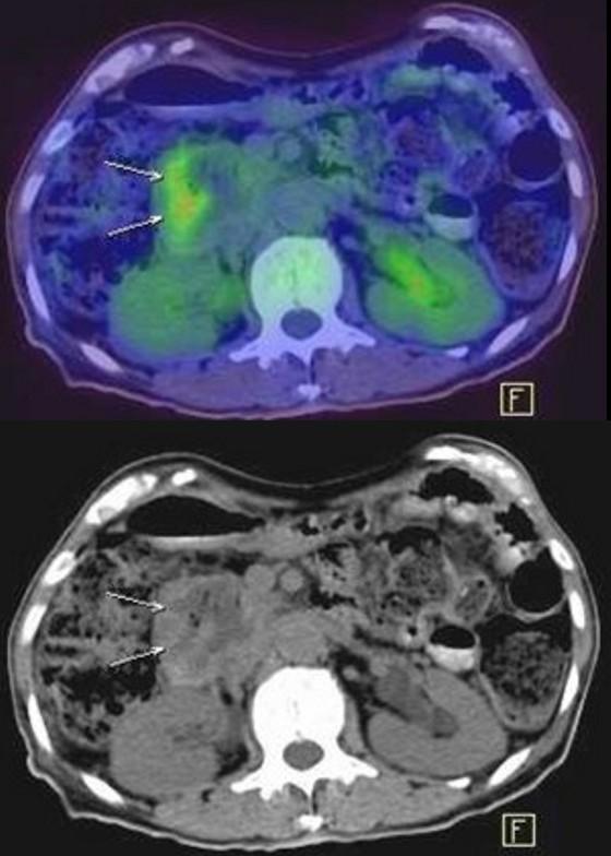 A total pancreatectomy was performed and the final histology revealed a main-duct type IPMN with a focus of high-grade dysplasia compatible with malignant