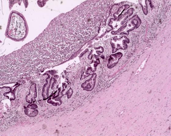 The surrounding pancreatic parenchyma was markedly atrophic with fibrosis and chronic inflammation compatible with chronic pancreatitis.