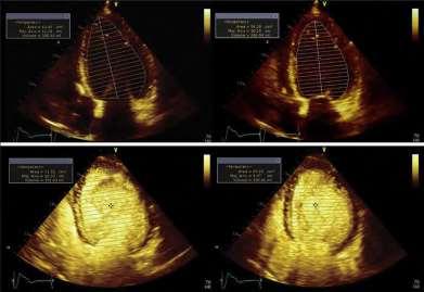 Endocardial Border Enhancement Helpful in patients with