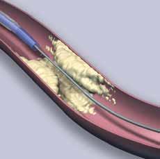 Your Treatment Options (continued) is removed from the artery. This opens the narrowing in the coronary artery and improves the blood flow to the heart muscle.