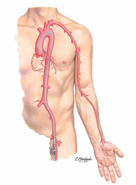 Your Drug Eluting Stent Procedure (continued) Blood vessel access for