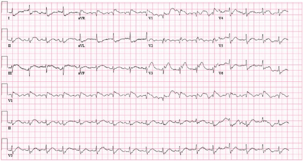 2 Case Reports in Medicine Figure 1: Electrocardiogram on admission showing ST segment elevation in inferior and anteroseptal distribution (STEMI from in-stent thrombosis).