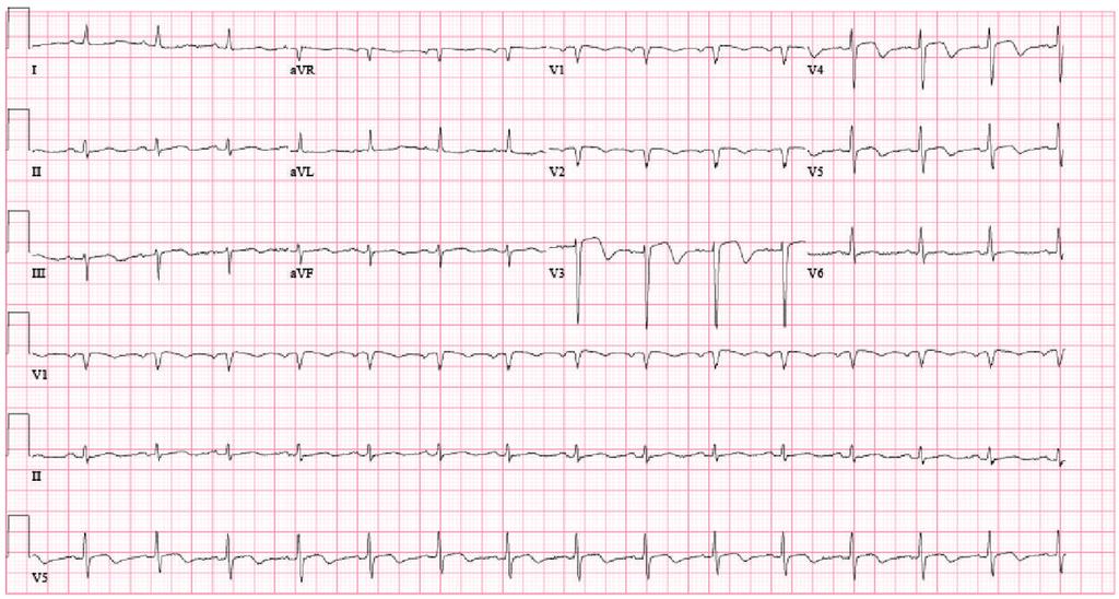 The electrocardiogram showed ST segment elevation in the inferior and anteroseptal leads (Figure 1).