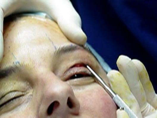 It is advisable that initially surgeons defer upper lid skin excision until after brow repositioning, but once comfortable with the procedure, the upper lid elliptical skin excision can be performed