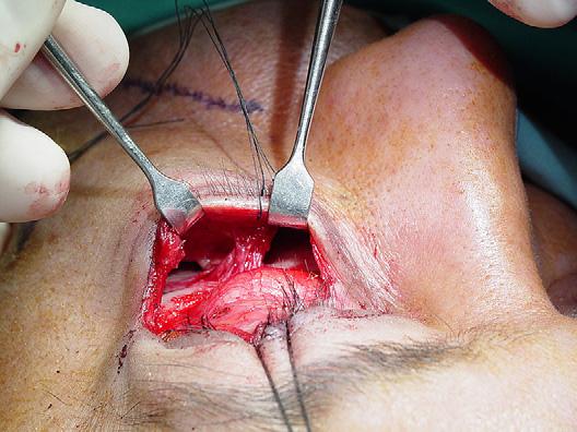 With the patient seated and the head and gaze in a neutral position, the surgeon identifies the bulk of the ptotic midfacial fat and subcutaneous tissue.