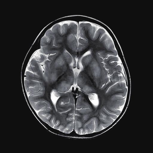390 YY Jang, et al. Transient white matter lesions following EV encephalitis brainstem area during the acute stages of the illness 1-3).