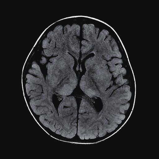 There have been several case reports of abnormal white matter lesions on successive brain magnetic resonance imaging (MRI) following herpes simplex encephalitis (HSE) regardless of clinical symptoms